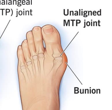 Wearing shoes isn't natural. The big toe is pushed inward toward the second toe. The constant pressure shifts the joint…
